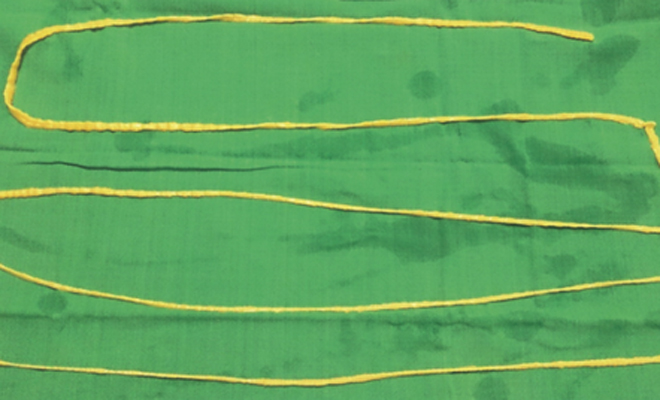 Кошмар во плоти: врачи удалили 2-метрового червя из желудка мужчины
