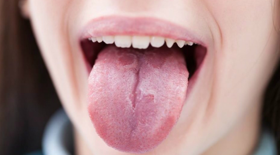 10 серьезных проблем организма, о которых расскажет ваш язык