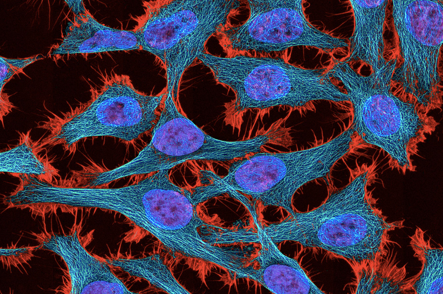 Клетки HeLa
В отлчие от обычных клеток эти обладают уникальной способностью делиться бесконечное число раз. Деление это возможно благодаря тому же ферменту теломераза: он наращивает теломеры на концах ДНК хромосом. Впервые они были обнаружены в раковой опухоли шейки матки Генриетты Лакс в 1951 году. Сейчас клетки HeLa используется для изучения рака, СПИДа и множества других болезней и различных веществ.
