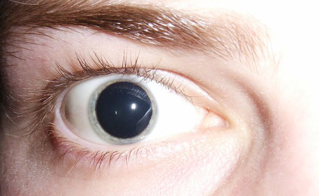 от марихуаны красные глаза