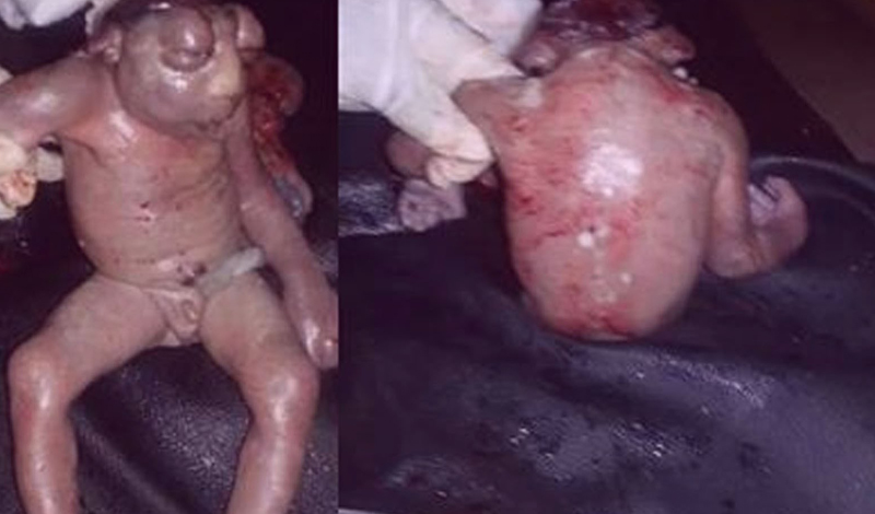 Лягушка-ребенок
Это единичный случай проявления страшной аномалии. Ребенок с анэнцефалией родился у матери двух нормальных дочерей. При анэнцефалии человек появляется на свет без основных частей мозга, черепа и кожи головы.