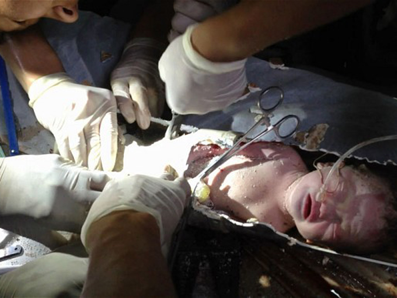 Ребенок
В 2013 году в Китае был обнаружен зажатый в канализационной трубе новорожденный младенец. Предположительно, 22-летняя мать малыша пошла в туалет, когда она начала чувствовать боль в животе, а затем ребенок выскользнул в канализационную трубу и она не смогла его спасти. Чудом ребенок выжил.